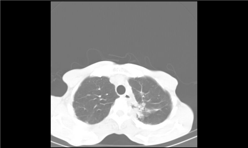 File:Aspergilloma (Radiopaedia 20788-20701 Axial lung window 8).jpg