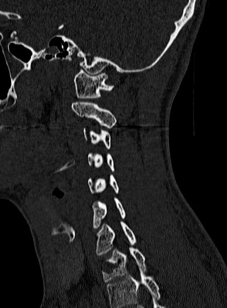 File:Atlantoaxial subluxation (Radiopaedia 44681-48450 Sagittal bone window 120).jpg