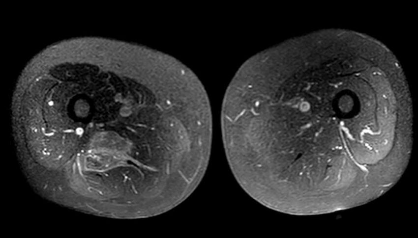 Atypical lipomatous tumor - thigh (Radiopaedia 68975-78734 Axial T1 C+ fat sat 54).jpg