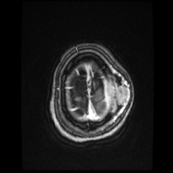 File:Atypical meningioma (Radiopaedia 45535-49629 Axial T1 C+ 60).jpg