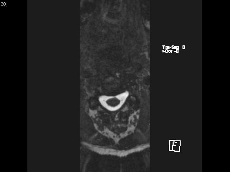 File:Atypical meningioma - intraosseous (Radiopaedia 64915-74572 Axial CISS 20).jpg