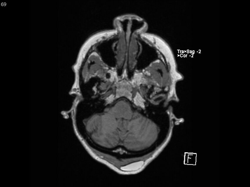 Atypical meningioma - intraosseous (Radiopaedia 64915-74572 Axial T1 69).jpg