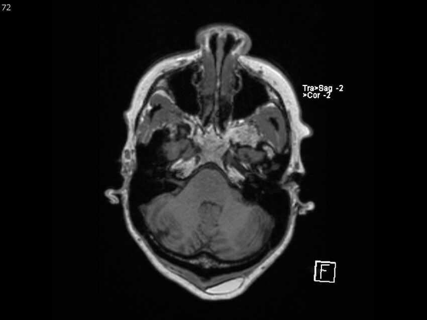 Atypical meningioma - intraosseous (Radiopaedia 64915-74572 Axial T1 72).jpg