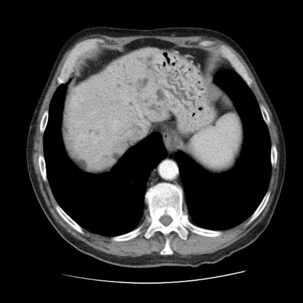 File:Autosomal dominant polycystic kidney disease (Radiopaedia 27851-28094 B 50).jpg
