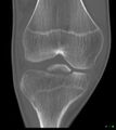 Avulsed ACL origin (Radiopaedia 17383-17070 Coronal bone window 1).jpg