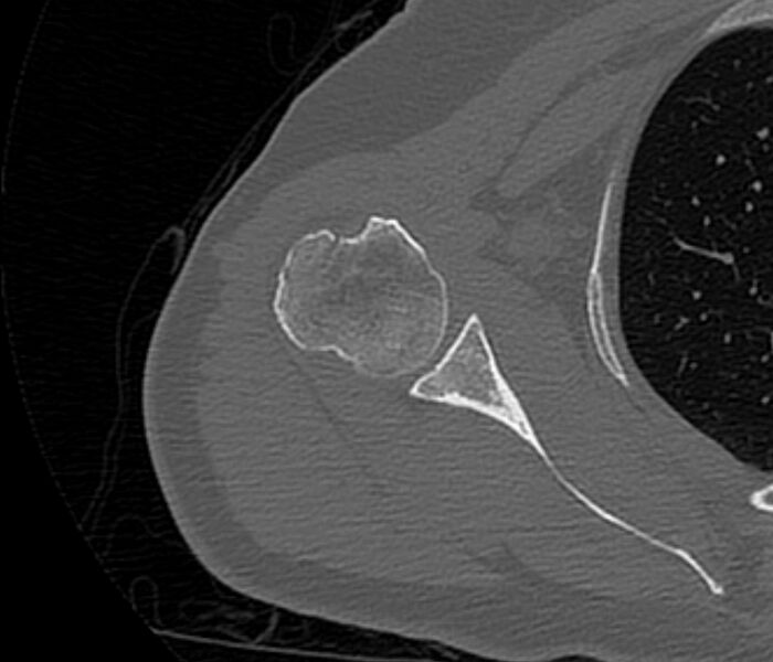 File:Avulsion fracture - greater tuberosity of humerus (Radiopaedia 71216-81514 Axial bone window 44).jpg