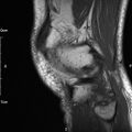 Avulsion fracture of the fibular head (Radiopaedia 74804-85808 D 28).jpg