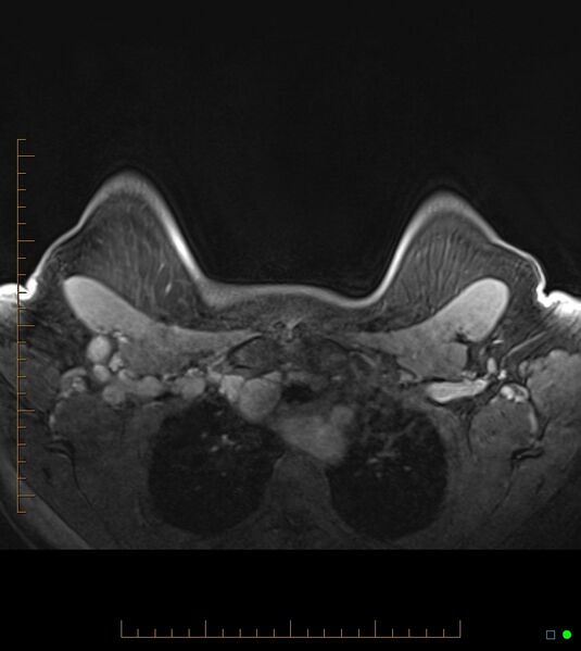 File:Axillary lymphadenopathy on breast MRI- yellow fever vaccination induced (Radiopaedia 19454-19483 Axial T1 C+ fat sat 11).jpg