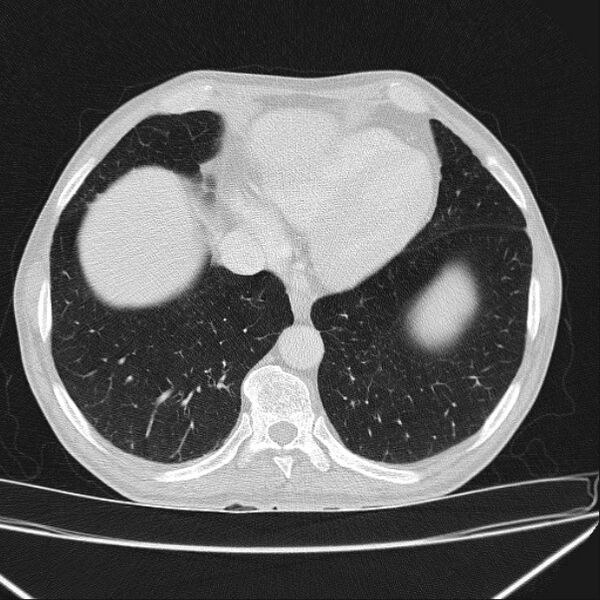 File:Azygos lobe (Radiopaedia 38259-40275 Axial lung window 64).jpg