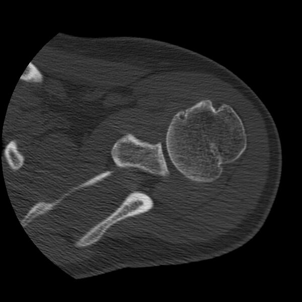 File:Bankart lesion (Radiopaedia 22771-22798 Axial bone window 18).jpg