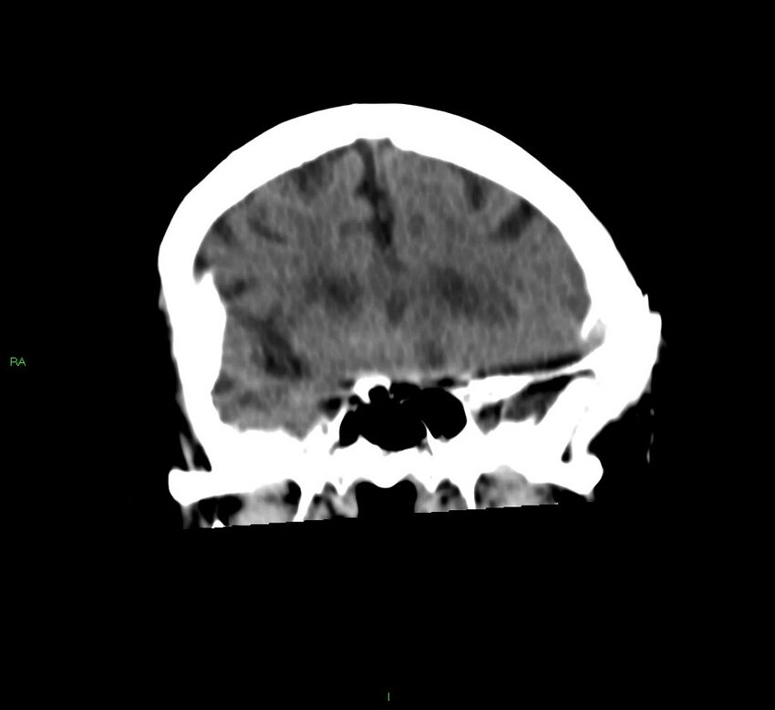 Basal ganglia hemorrhage (Radiopaedia 58790-66024 Coronal non-contrast 40).jpg