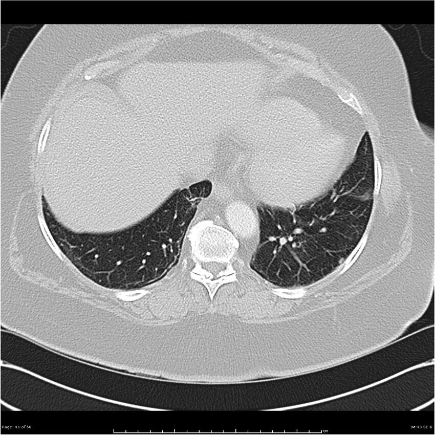 Benign metastasizing leiomyoma (Radiopaedia 26803-26962 Axial lung window 41).jpg