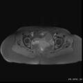 Bicornuate uterus- on MRI (Radiopaedia 49206-54297 Axial T1 fat sat 14).jpg