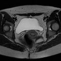 Bicornuate uterus (Radiopaedia 72135-82643 Axial T2 14).jpg