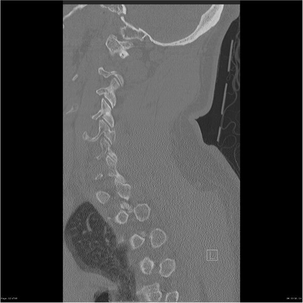 File:Bilateral cervical ribs (Radiopaedia 25868-26017 Sagittal bone window 52).jpg