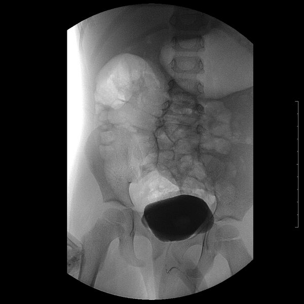 File:Bilateral duplex kidneys with left-sided uterocoele (Radiopaedia 20811-20726 A 1).jpg
