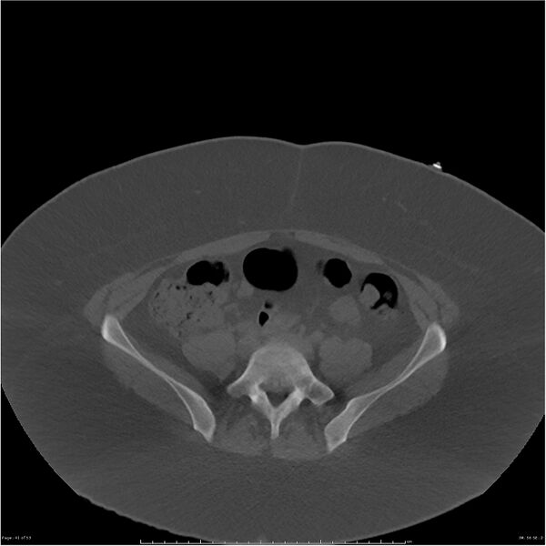 File:Bilateral lumbar ribs (Radiopaedia 25862-26010 bone window 41).jpg