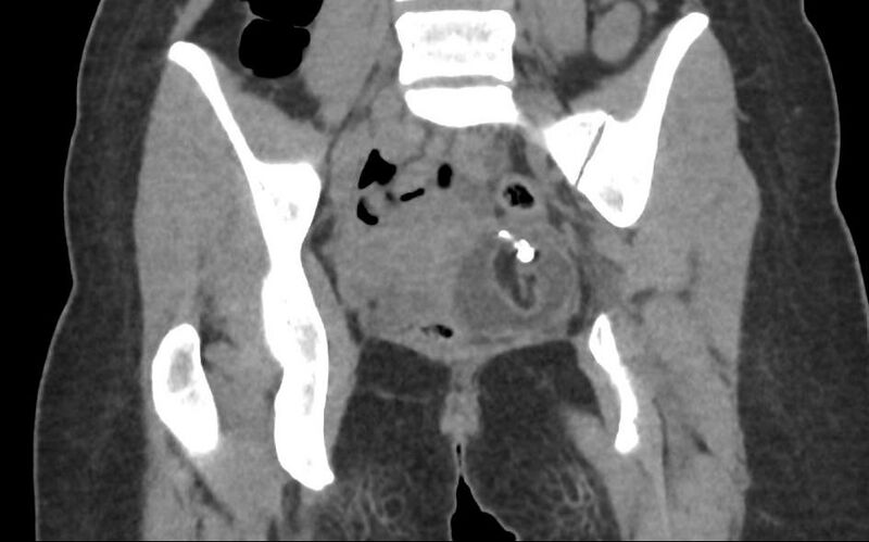 File:Bilateral mature cystic ovarian teratoma (Radiopaedia 88821-105592 Coronal non-contrast 21).jpg
