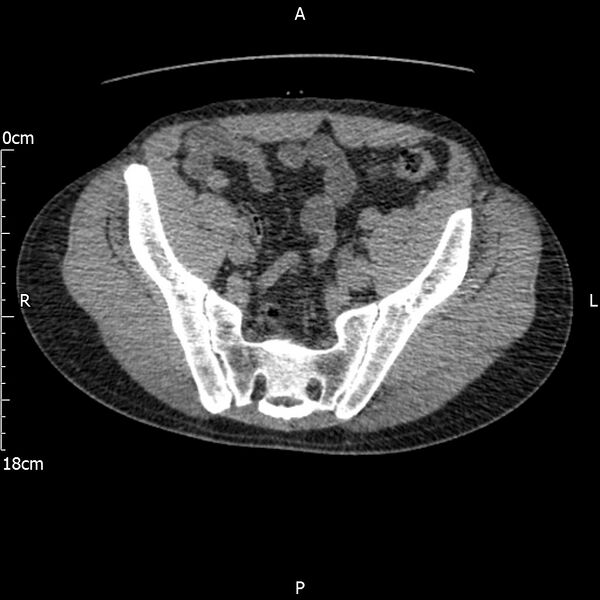 File:Bilateral medullary nephrocalcinosis with ureteric calculi (Radiopaedia 71269-81569 Axial non-contrast 104).jpg