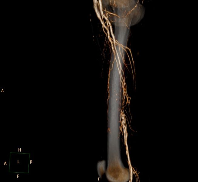 File:Bilateral superficial femoral arterial occlusion (Radiopaedia 25682-25857 3D VR 16).jpg