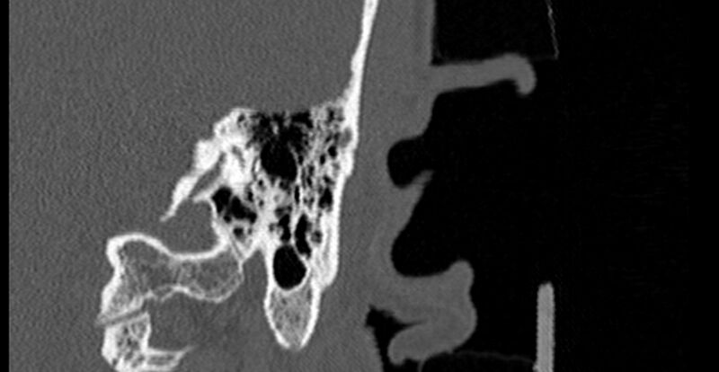 File:Bilateral temporal bone fractures (Radiopaedia 29482-29970 B 69).jpg