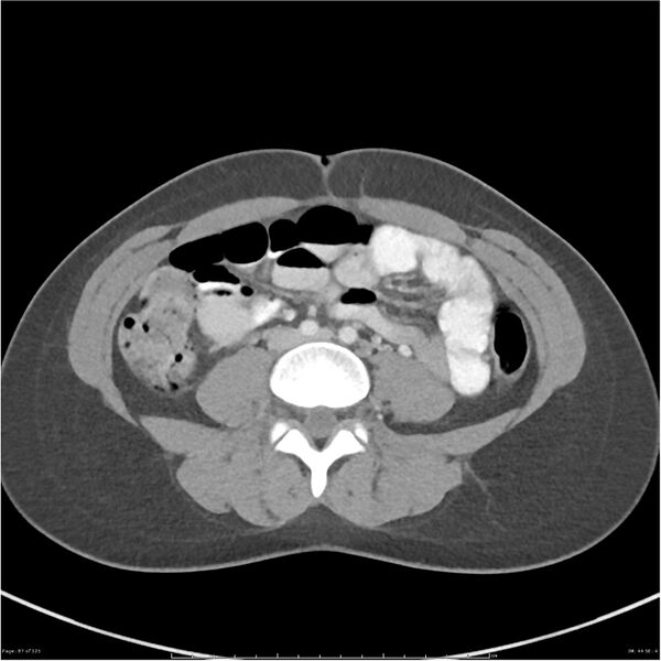 File:Bilateral ureteritis and cystitis (Radiopaedia 25340-25594 A 44).jpg