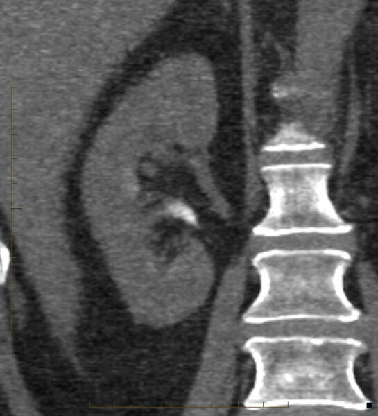File:Bile leak from accessory duct(s) of Luschka post cholecystectomy (Radiopaedia 40736-43389 B 52).jpg