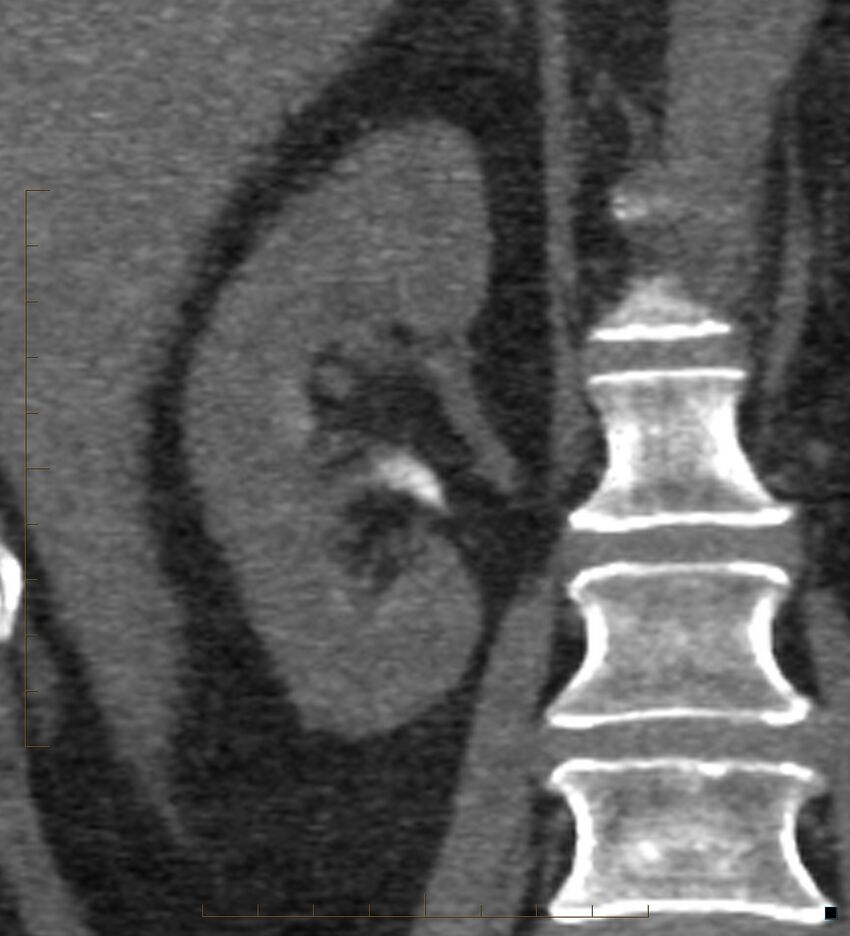 Bile leak from accessory duct(s) of Luschka post cholecystectomy (Radiopaedia 40736-43389 B 52).jpg