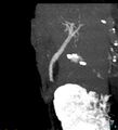 Bile leak from accessory duct(s) of Luschka post cholecystectomy (Radiopaedia 40736-43389 D 25).jpg