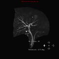 Biliary tree anatomical variant - biliary trifurcation (Radiopaedia 12531-12750 Coronal 3D MRCP 1).jpg