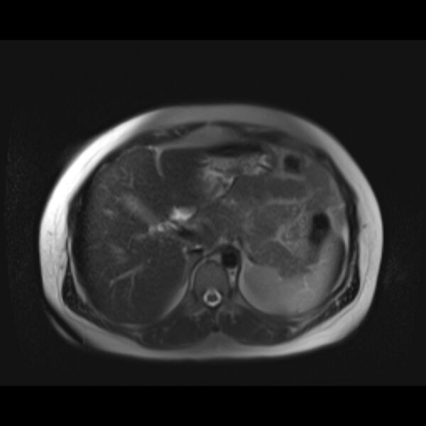 File:Bilobed placenta accreta (Radiopaedia 69648-79591 Axial T2 fat sat 4).jpg