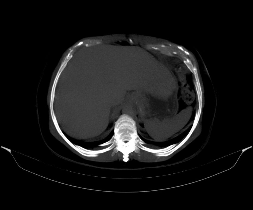 Blind-ending branch of a bifid ureter (Radiopaedia 43613-47034 Axial MIP 21).jpg