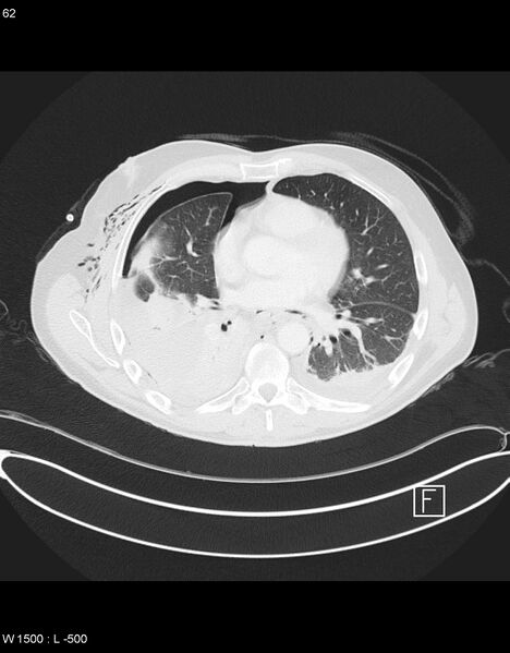 File:Boerhaave syndrome with tension pneumothorax (Radiopaedia 56794-63605 Axial lung window 30).jpg