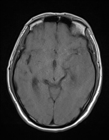 File:Brain abscess with ventriculitis (Radiopaedia 85703-101495 Axial T1 12).jpg