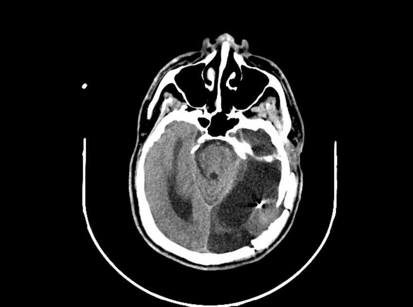 Brain injury by firearm projectile (Radiopaedia 82068-96088 A 102).jpg