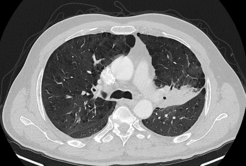 Brain metastases - lung cancer primary (Radiopaedia 75060-86116 Axial lung window 21).jpg