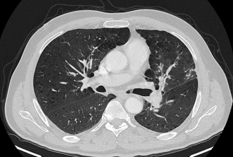 File:Brain metastases - lung cancer primary (Radiopaedia 75060-86116 Axial lung window 26).jpg
