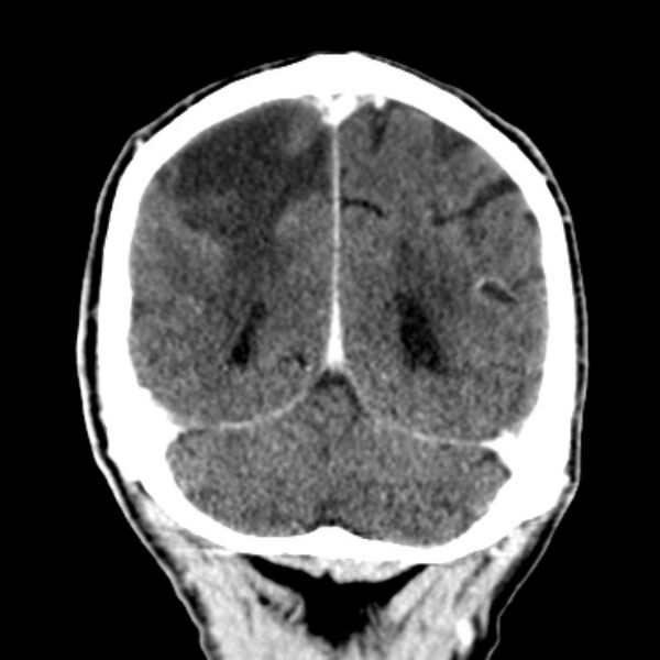 File:Brain metastases from lung cancer (Radiopaedia 27849-28092 Coronal C+ delayed 51).jpg