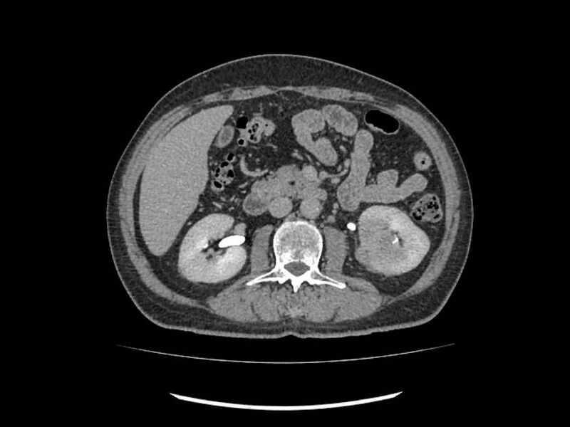 File:Brain metastases from renal cell carcinoma (Radiopaedia 42222-45328 Axial C+ delayed 106).jpg