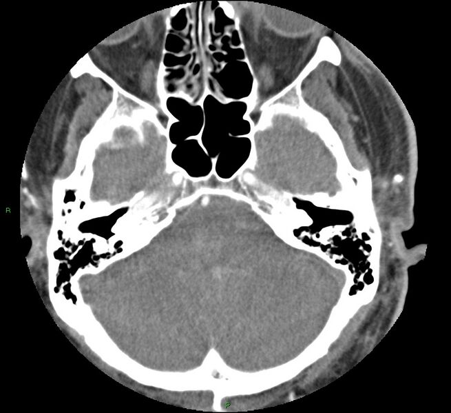 File:Brainstem hemorrhage (Radiopaedia 58794-66028 D 45).jpg