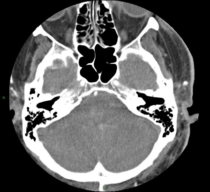 Brainstem hemorrhage (Radiopaedia 58794-66028 D 45).jpg