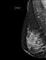 Breast hamartoma (Radiopaedia 65421-74481 MLO 1).jpg
