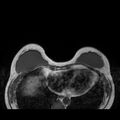 Breast implants - MRI (Radiopaedia 26864-27035 Axial T1 16).jpg