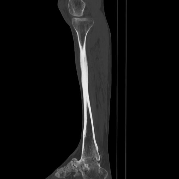 File:Brodie abscess - tibia (Radiopaedia 66028-75204 Sagittal bone window 21).jpg