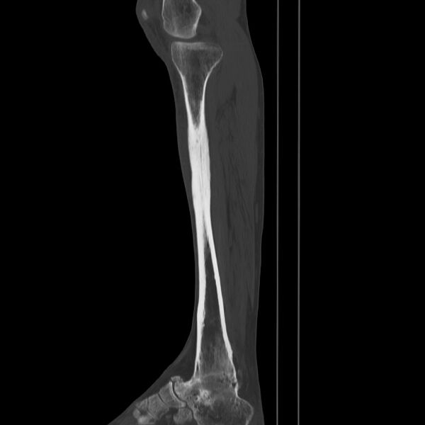 File:Brodie abscess - tibia (Radiopaedia 66028-75204 Sagittal bone window 23).jpg