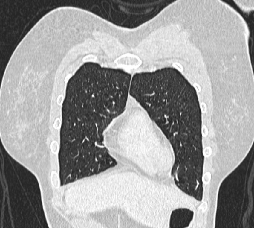 Bronchial atresia (Radiopaedia 50007-55297 Coronal lung window 11).jpg