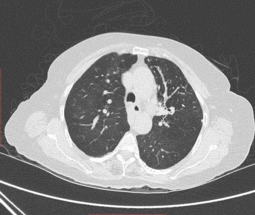 Bronchiectasis (Radiopaedia 72693-83293 Axial lung window 40).jpg