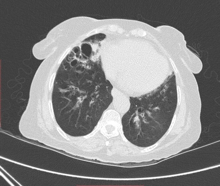 Bronchiectasis (Radiopaedia 72693-83293 Axial lung window 96).jpg