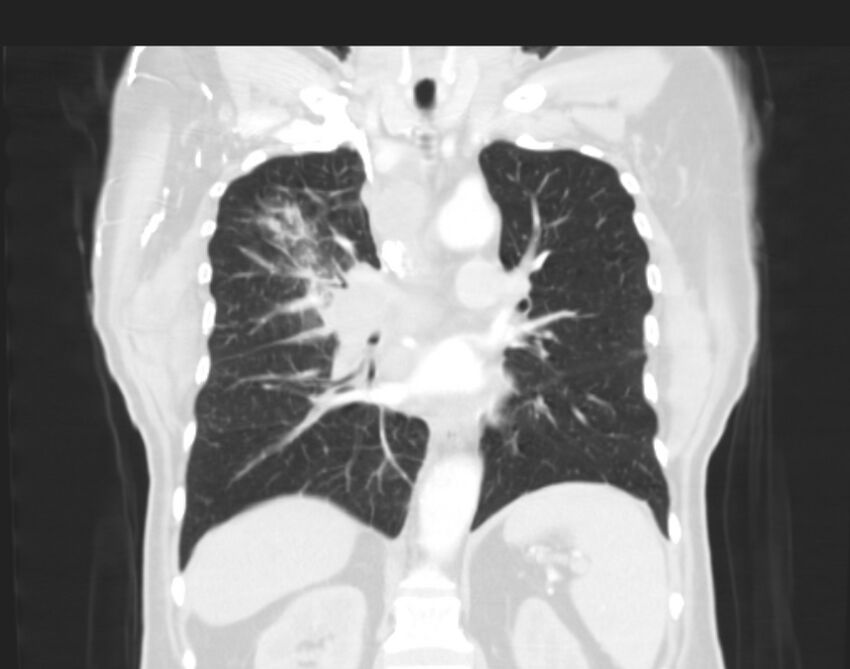 Bronchogenic carcinoma with lymphangitic spread (Radiopaedia 29002-29357 Coronal lung window 38).jpg