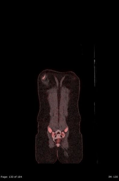File:Brown fat uptake (FDG PET-CT) (Radiopaedia 77392-89513 Fused coronal 88).jpg
